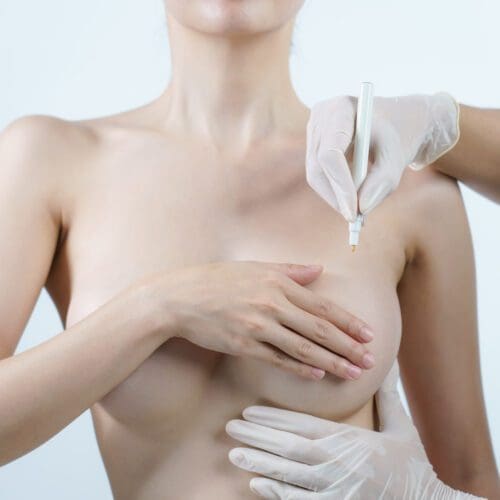 Doctor hand drawing lines on woman breast, breast implant surgery concept.