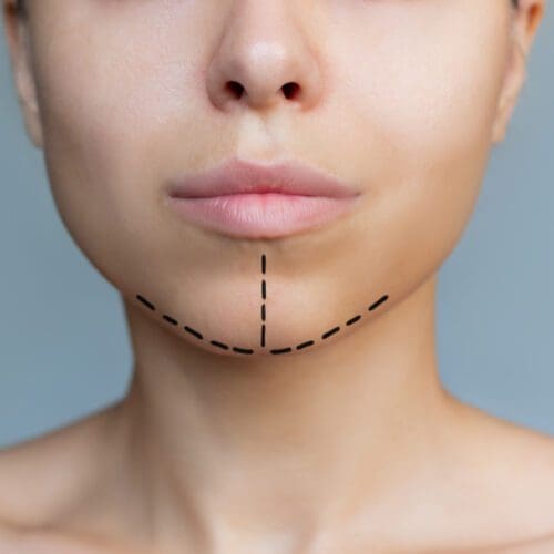 Chin Implant Surgery