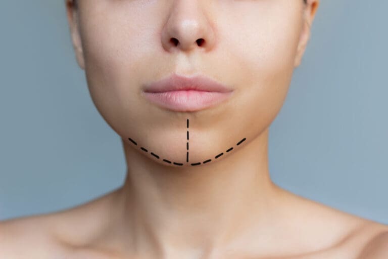 Chin-Implant-Surgery