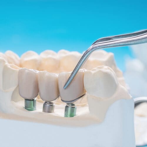 Close up Implant model tooth support fix bridge implant and crown.