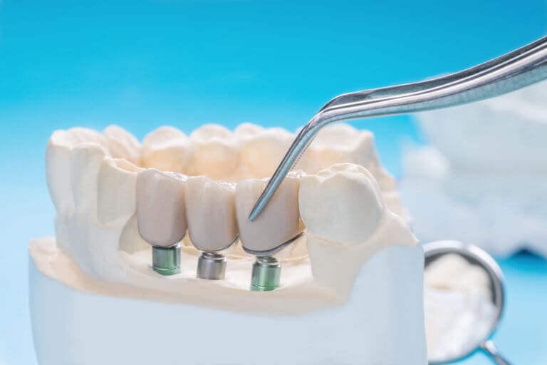 Close up Implant model tooth support fix bridge implant and crown.