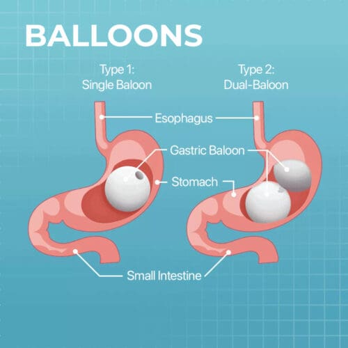 Gastric Balloons weight loss surgery