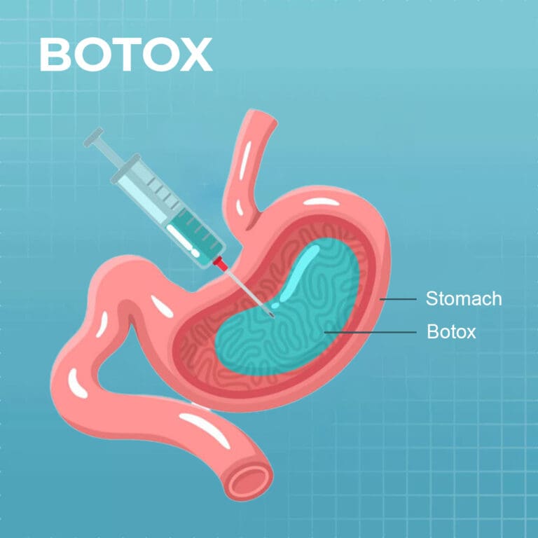 Gastric Botox weight loss surgery