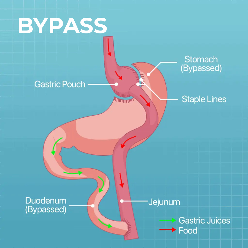 Gastric Bypass - Turkey Medical Holidays