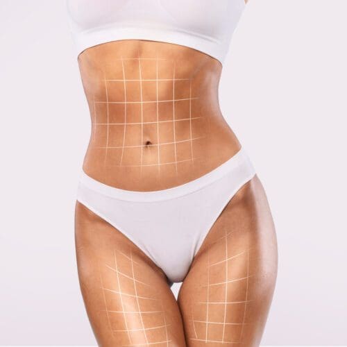 Body Shaping Concept. Slim Female With Lifting Up Lines On Figure Posing In Underwear Over White Studio Background, Fit Sporty Woman Demonstrating Cosmetic Surgery Result, Collage, Copy Space