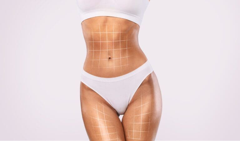 Body Shaping Concept. Slim Female With Lifting Up Lines On Figure Posing In Underwear Over White Studio Background, Fit Sporty Woman Demonstrating Cosmetic Surgery Result, Collage, Copy Space