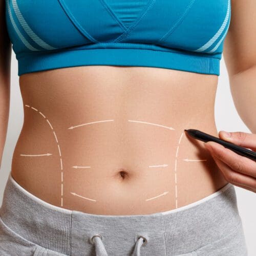 a woman shows a dotted line on her body liposuction zone. on white background