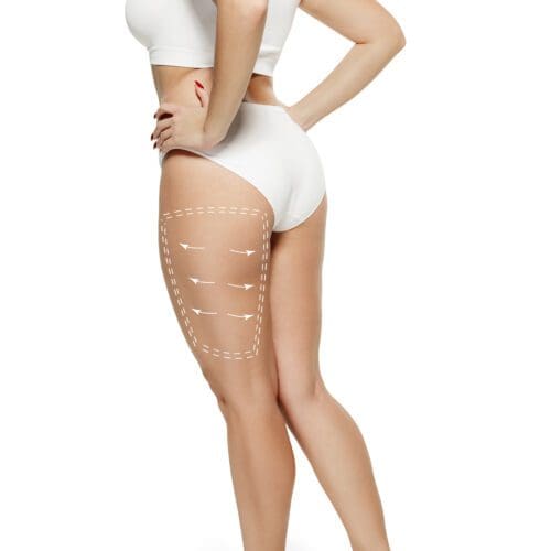 Female body with the drawing arrows. Fat lose, liposuction and cellulite removal concept. Marks on the woman before plastic surgery. Image is not body shape retouched