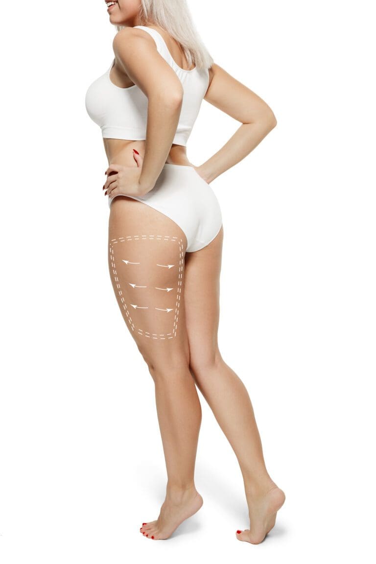 Female body with the drawing arrows. Fat lose, liposuction and cellulite removal concept. Marks on the woman before plastic surgery. Image is not body shape retouched